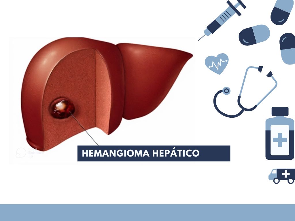 Hemangioma Hepático: Entendendo o Tumor mais Comum no Fígado