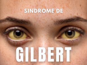 Sindrome de Gilbert